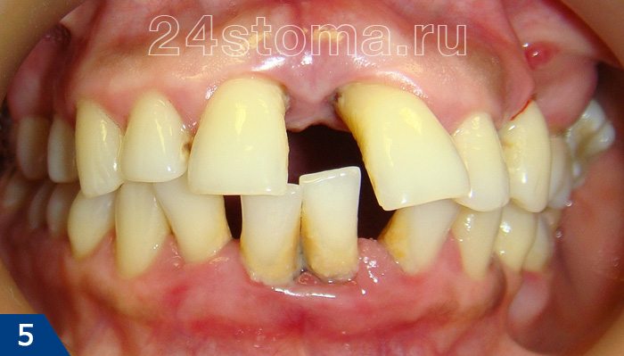 Веерообразное расхождение верхних зубов, оголение шеек нижних зубов вследствие атрофии костоной ткани при пародонтите