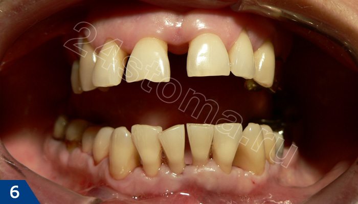 Веерообразное расхождение зубов, оголение шеек зубов при пародонтите
