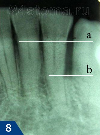 Рентгенограмма: глубокий пародонтальный карман между нижним боковым резцом и клыком