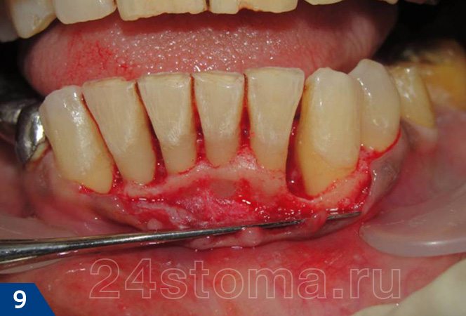 Отслоен лоскут слизистой оболочки от зубов и кости; создан доступ к пародонтальнмуо карману