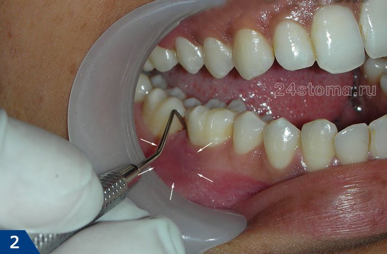 Локализованный пародонтит (стрелочками ограничен очаг воспаления десны в области 6 зуба). Причина - травматический преждевременный контакт с верхним зубом.