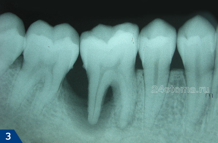 Рентгенограмма зуба с локализованным пародонтитом с рис.2 (виден большой очаг разрушения кости в области дистального корня 6 зуба и межзубном промежутке)