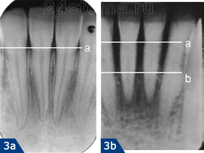 Сравнение рентгенограммы с отсутствием следов атрофии кости (3a) - с рентгенограммой, на которой отмечается атрофия на 1/2 длины корня зуба (3b)