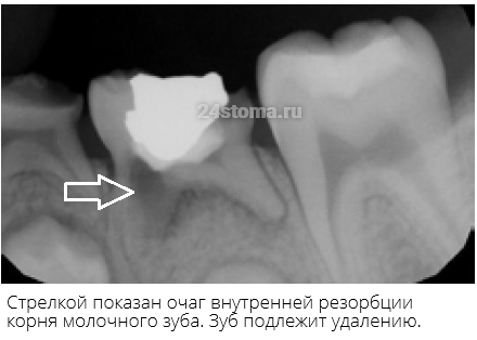 Пример молочного зуба, корни которого подвержены резорбции (подлежит удалению)