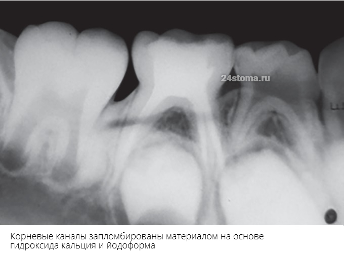 Корневые каналы в молочном зубе запломбированы материалом на основе гидроксида кальция и йодоформа