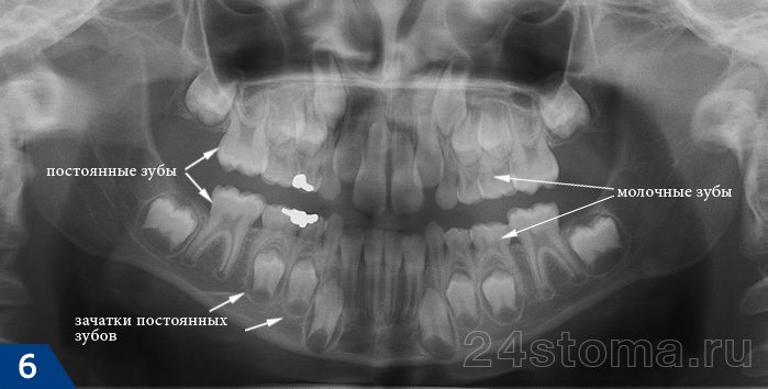 Панорамный рентгеновский снимок всех зубов у ребенка (обратите внимание, что зачатки постоянных зубов находятся практически между корнями молочных зубов)