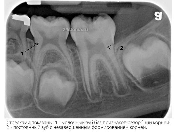 1 - Молочный зуб с полностью сформированными корнями и без признаков  их резорбции, 2 - постоянный зуб с незавершенным формированием корней.