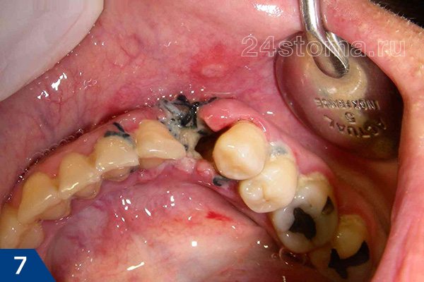Альвеолит лунки удаленного зуба (лунка частично заполнена распадом кровяного сгустка и пищевыми остатками, обнажена костная ткань)