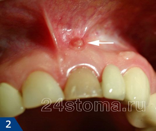 Свищевое отверстие на поверхности десны (показано стрелочкой). Коронковая часть зуба полностью восстановлена пломбой.