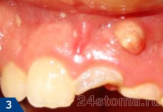 Киста на десне у ребенка (причинный зуб имеет перелом коронки в результате травмы)