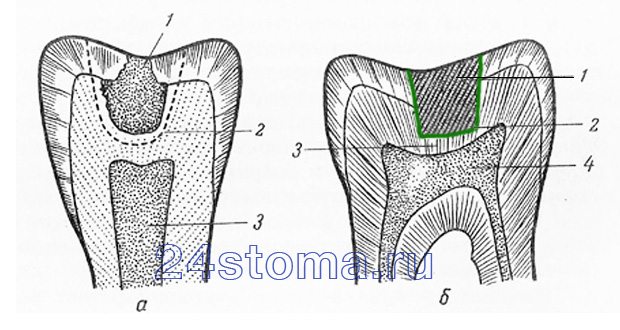 Схема (а) - граница высверливания кариозных тканей. Схема (б) - пломбирование дефекта зуба.