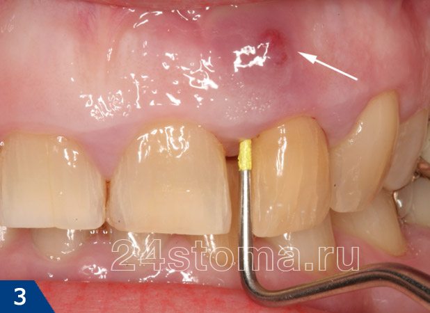 Трещина корня зуба лечение свищ thumbnail