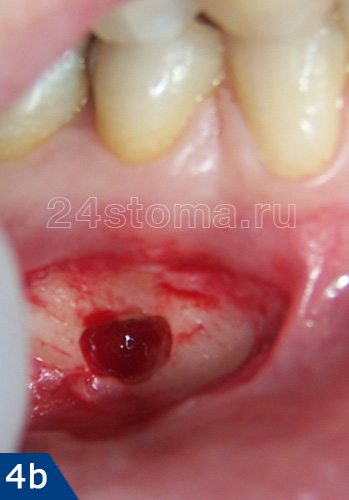 Создание доступа к кисте нижнего зуба: проведен разрез, отслоена слизистая, выпилено окошко в кости в проекции кисты