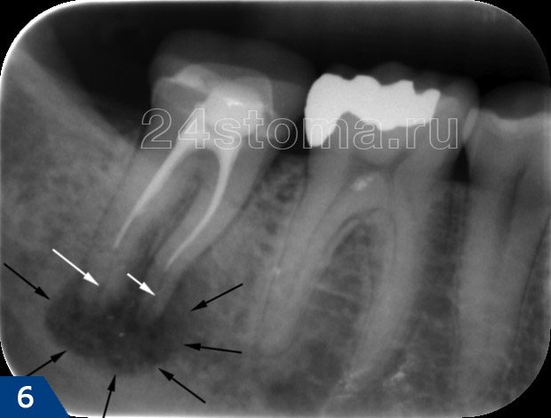 Киста нижнего зуба (ограничена черными стрелками). Недопломбированные участки  каналов показаны белыми стрелками