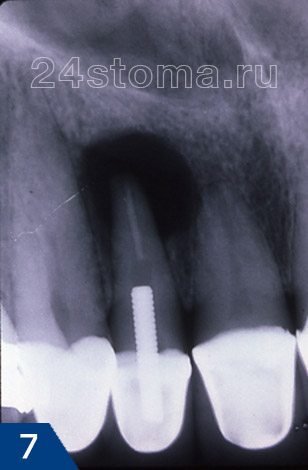 Киста верхнего зуба (выглядит как интенсивное затемнение у верхушки корня). Причина образования - плохо запломбированный корневой канал