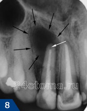 Исходная ситуация: киста корня зуба (выглядит какинтенсивное затемнение), недопломбированный участок канала показан белой стрелкой