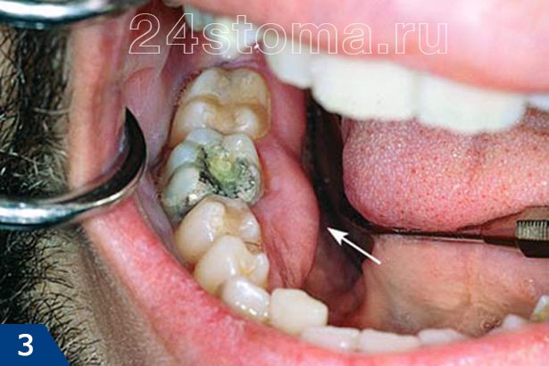 Флюс на десне с внутренней стороны зубного ряда (показан стрелкой)