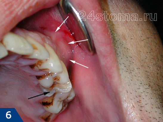 В полости рта: по переходной складке между десной и щекой резко болезненный инфильрат (показан белыми стрелочками), причинный зуб показан черной стрелкой