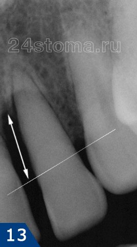 Рентгенограмма: стрелочкой показан уровень потери костной ткани у зуба, в проекции которого образовался пародонтальный абсцесс