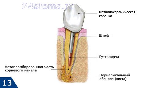 Киста корня зуба, образовавшаяся из-за некачественного пломбирования корневого канала (схема)