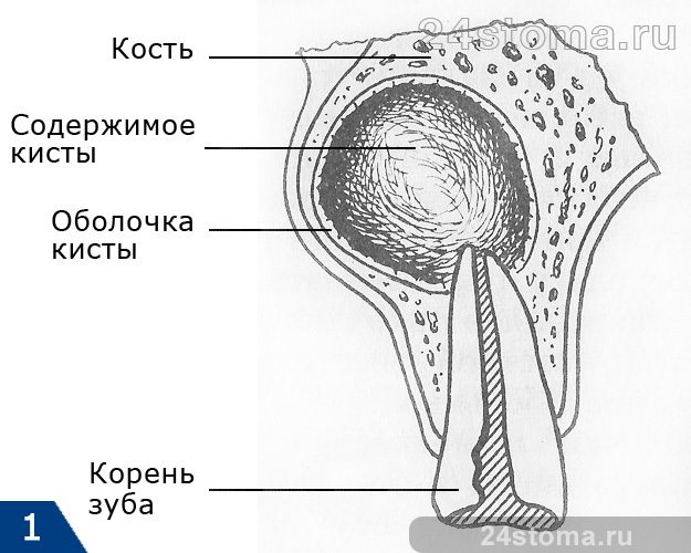 Схема кисты корня зуба
