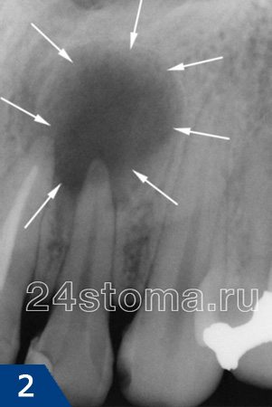 Рентгенограмма -корневая киста бокового верхнего резца (ограничена белыми стрелками)