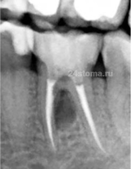 Корневая киста, расположенная между корнями многокорневого зуба (6 нижний зуб)