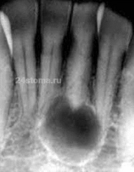 Корневая (радикулярная) киста, расположенная у верхушки корня зуба