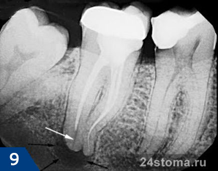 Периодонтальный абсцесс (ограничен черными стрелками) в области верхушек корней нижнего зуба