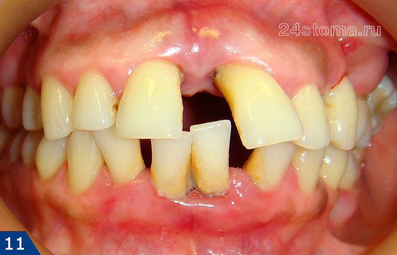 Пародонтит тяжелой степени, веерообразное расхождение зубов