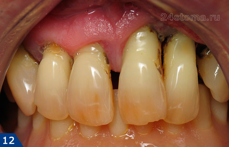 Пародонтит тяжелой степени, полное разрушение костной ткани у передних верхних зубов, оголение корней зубов