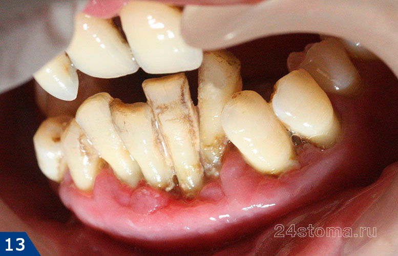 Пародонтит тяжелой степени, полное разрушение костной ткани у передних зубов, смещение зубов