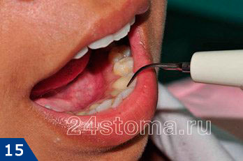 Ультразвуковой наконечник для удаления зубных отложений