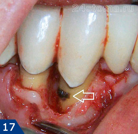 После хирургической отслойки десны визуализирован пародонтальный карман, и расположенный на поверхности корня зуба - твердый зубной камень