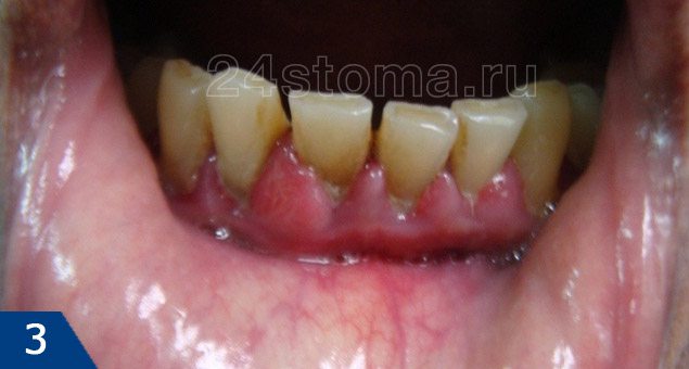 Нижняя десна отходит от зуба лечение thumbnail