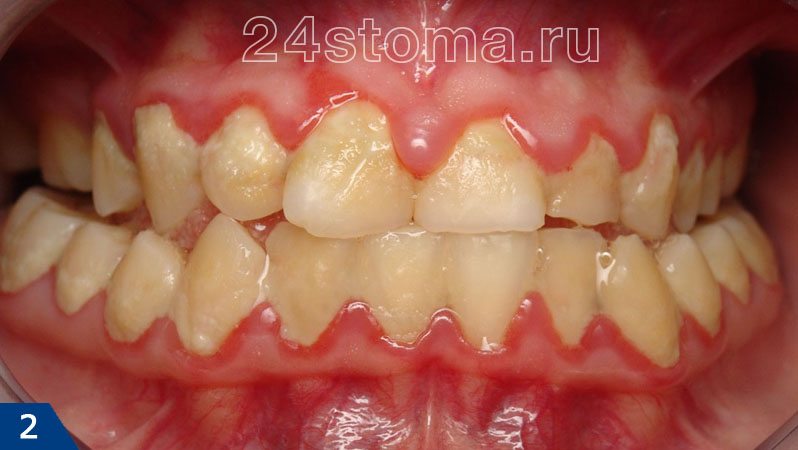 Катаральный гингивит (массивные скопления мягкого микробного зубного налета в области всех зубов)