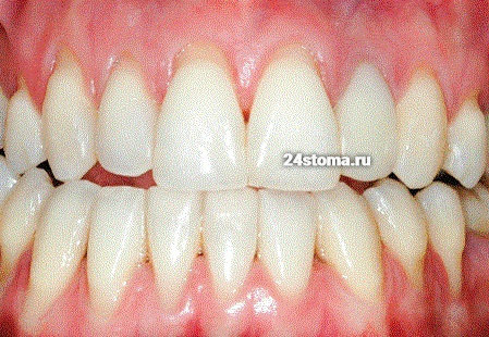 Пример оголения корней зубов - в результате длительного травматического воздействия зубной щеткой