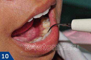 Ультразвуковой наконечник для удаления зубных отложений