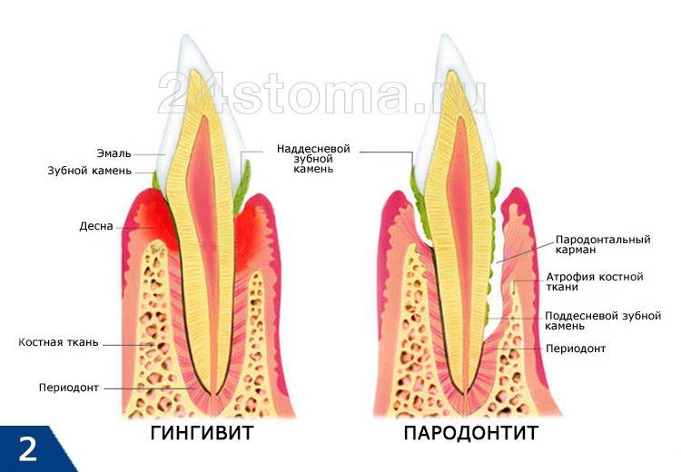 Отличия гингивита от пародонтита (схема). Воспалительная резорбция кости при пародонтите приводит к образованию пародонтальных карманов и разрушению зубо-десневого прикрепления (в результате чего и появляется подвижность зубов)