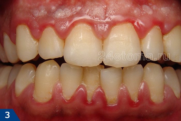 Острый катаральный гингивит (обратите внимание на скопления мягкого зубного налета вокруг шеек зубов, а также покраснение десневых сосочков)