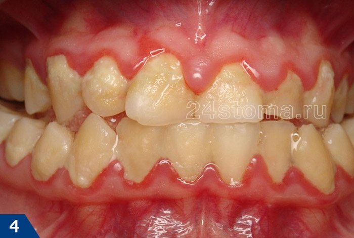 Острый катаральный гингивит (массивные скопления мягкого зубного налета у шеек зубов, резкое покраснение краевой десны)