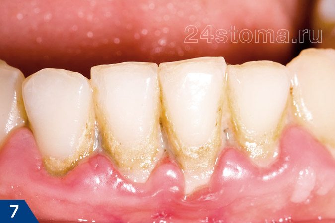 Скопления мягкого микробного зубного налета, а также частично минерализованного микробного налета в области шеек зубов