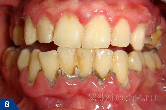 Большое количество твердых зубных отложений в области шеек большинства зубов