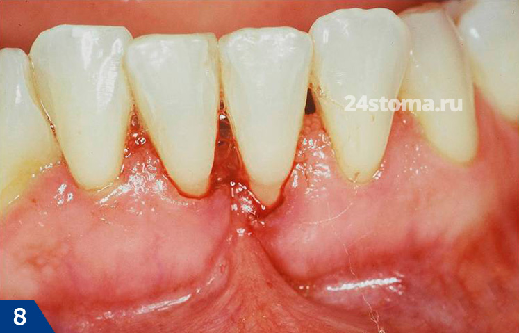 Высоко прикрепленная уздечка нижней губы вызывает отрыв десневого края от шеек зубов (с образованием рецессии десны)