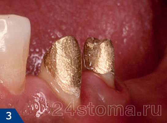 Вид зубов после их восстановления культевыми вкладками