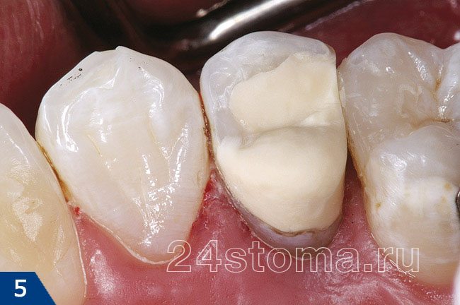 Восстановление коронковой части зуба пломбировочным материалом