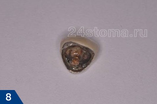 Металлокерамическая коронка вместе со штифтом извлечена из зуба (диагностирован перелом корня)