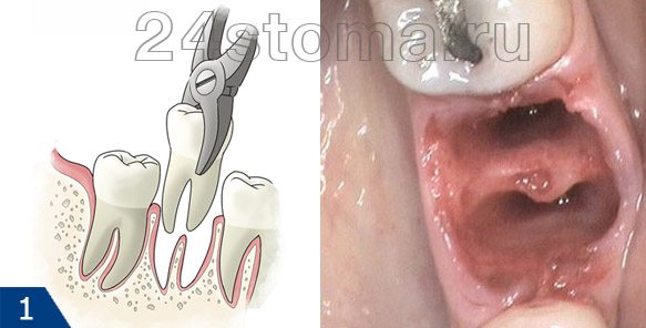 Вид лунки удаленного двухкорневого зуба (сразу после извлечения зуба)