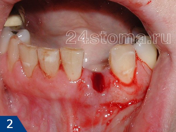 Вид лунки удаленного зуба, заполненной кровяным сгустком