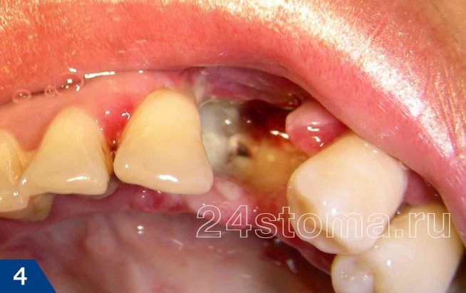 Альвеолит лунки удаленного зуба
